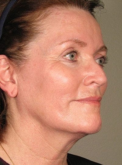 Ultherapy Before & After