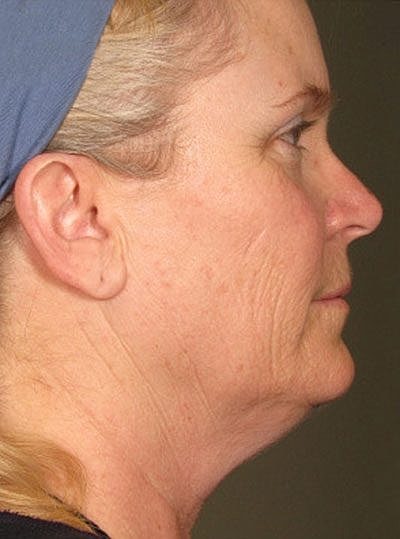 Ultherapy Before & After