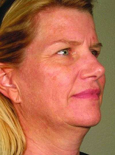 Ultherapy Before & After