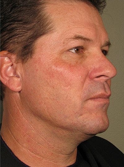 Ultherapy Before & After