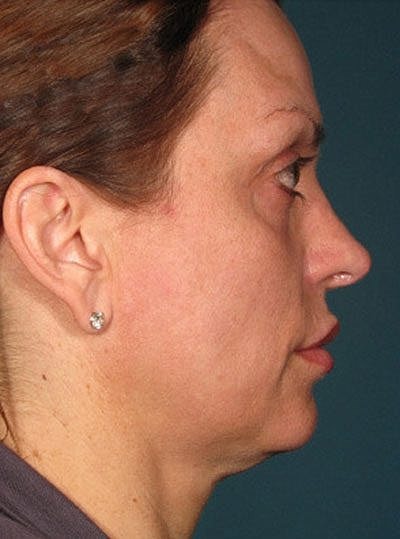 Ultherapy Before & After