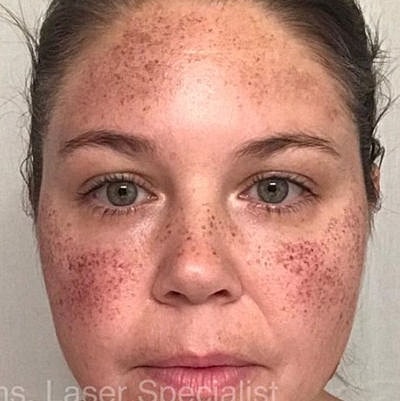 Laser Before & After