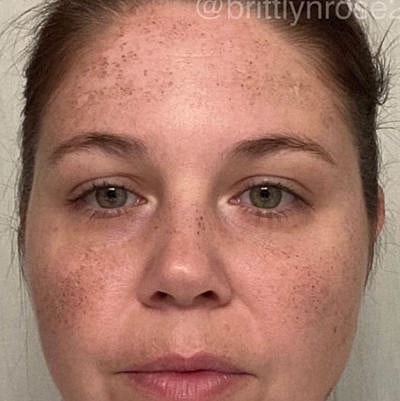 Laser Before & After