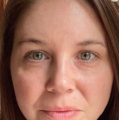 Laser Before & After